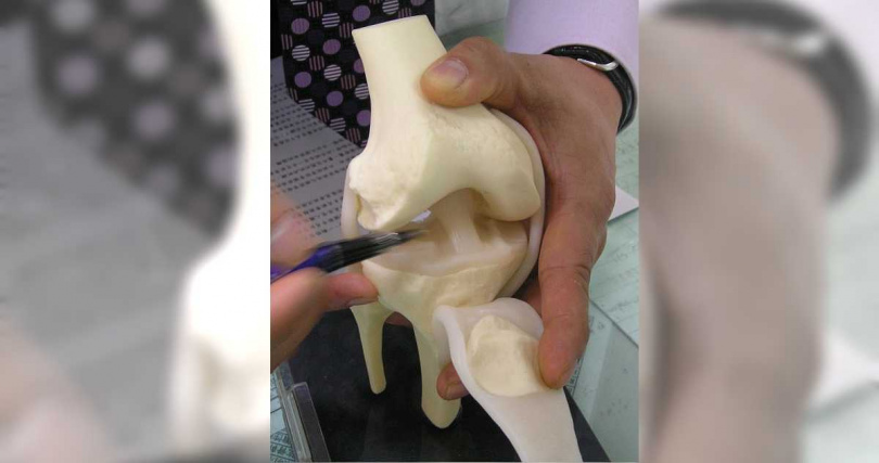 CTWANT調查，保戶在接受治療膝蓋受傷、退化等所使用的「羊膜異體移植（粉劑生長因子）」，為保險公司實支實付險「拒賠」的一大項目，圖為半月軟骨示意圖。（圖／報系資料照）