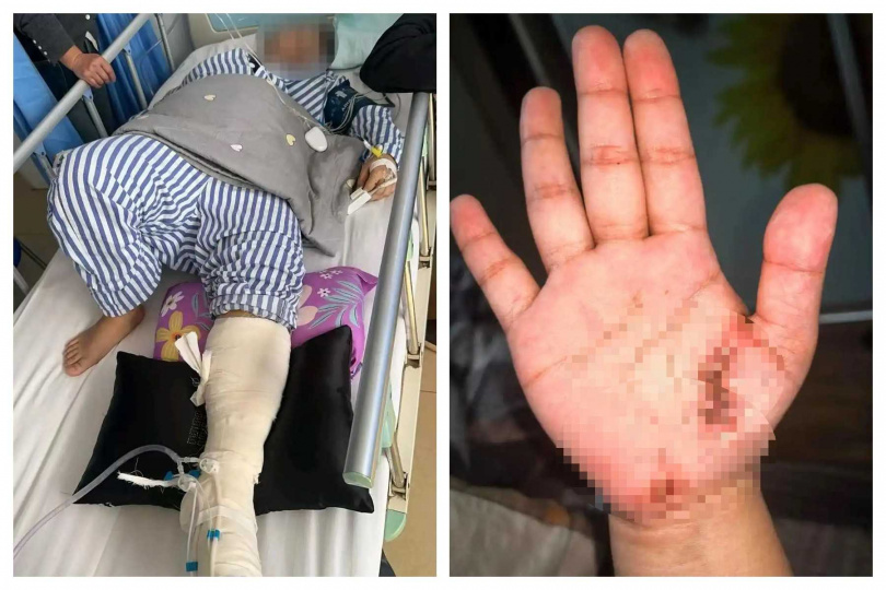 孫姓女子躺在沙發上邊充電邊刷手機，疑因充電設備問題遭電擊，右手、左腳及口唇舌部均留下傷勢。