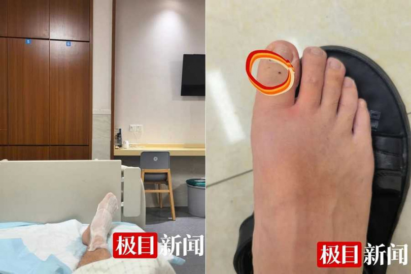 黃男穿涼鞋,不小心被蛇咬。(圖/翻攝自極目新聞)