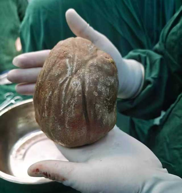 所幸經手術,醫師成功從阿強(化名)體內取出巨型結石,才沒危及生命。(圖/翻攝自微博/廣州日報)