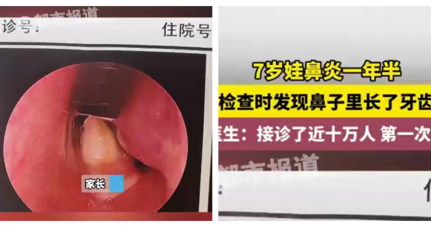 醫師透過電腦斷層掃描發現，男童鼻腔內竟異常生長出一顆牙齒，情況罕見，需透過手術處理。（圖／翻攝自微博）