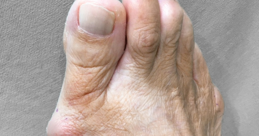 圖說-拇指外翻怎根治？關鍵在於嚴重程度！醫師一次解析：常見「5症狀」、「2種」治療方式！