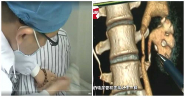 1500人只有1人!腰痛血尿就診 醫一看傻眼:竟然長三顆