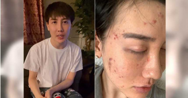 蛇精男確診消失半年!康復後首露面「無修圖照曝光」 網驚:變正常不少