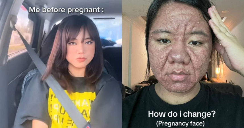 馬來西亞吉一名女子在懷孕後臉部異常腫脹，還長出多條皺紋。（圖／翻攝自TikTok／ayyitslala）