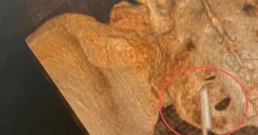 大陸湖北省武漢市一名胡姓女子近日在體檢時意外發現，體內有一段約2公分的異物。（圖／翻攝自紅星新聞）