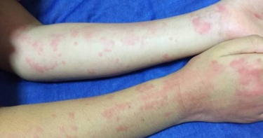 台北市新增1例麻疹境外移入確定病例。（示意圖／翻攝自photoAC）