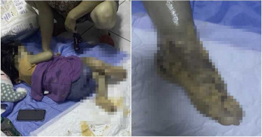 台南女童「腳丫燙成黑色」半月沒送醫 網爆怒!母冷回:沒必要跟你解釋