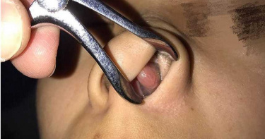 鼻噴劑也會引滿口蛀牙 醫師指張口呼吸惹禍