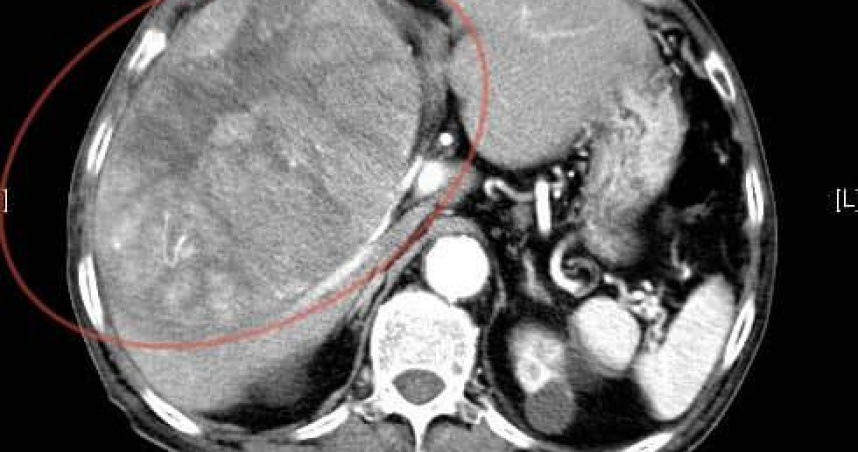 老翁肝臟有個15公分大的腫瘤，剛開始治療不久便病逝。（圖／翻攝自臉書／錢政弘 胃腸肝膽科醫師）