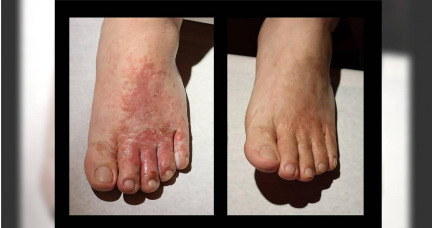50歲男性因大雨潮溼而患香港腳。（圖／翻攝畫面）