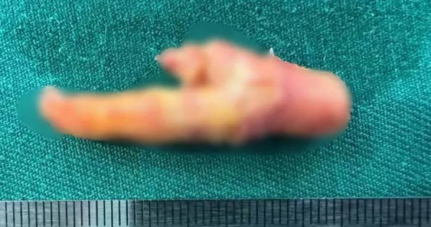 醫生從血管壁剝離出形似雞爪的厚厚斑塊。（圖／翻攝自寧波晚報）