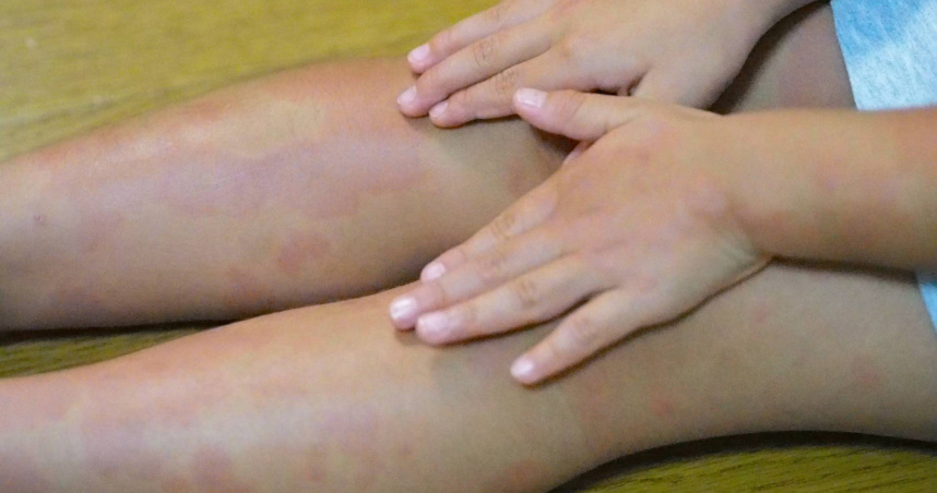 醫師提醒，梅毒不僅會透過性接觸傳播，如發現類似症狀，務必及早就醫治療。圖僅示意，與本文無關。（示意圖／photoAC）