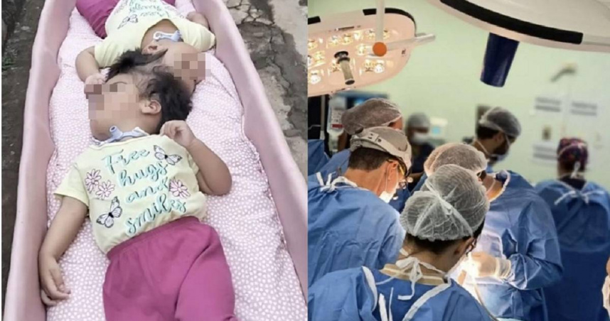 巴西一對年僅2歲的連體女嬰在1年內接受5次分離手術，近日在最後一次手術中不幸身亡。（圖／翻攝自X／New York Post）