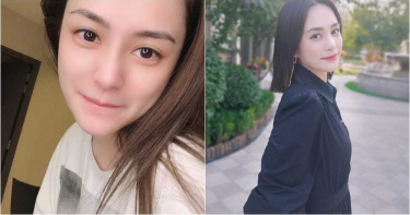 阿嬌眉骨撞破!再動第二次手術 頭部光表層重縫「挨66針」眼額腫脹劇痛