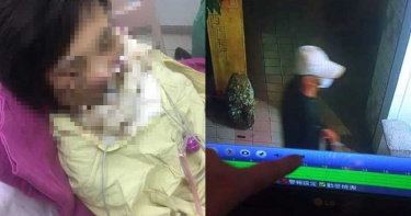 遭口罩男潑硫酸!台南正妹臉灼傷 「治療4年慘毀容」崩潰:幫我找凶手