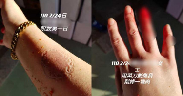 齒痕悚照曝!前空姐「大丈夫7歲」婆婆秒變臉:還生得出? 咬人菜刀削肉爆血