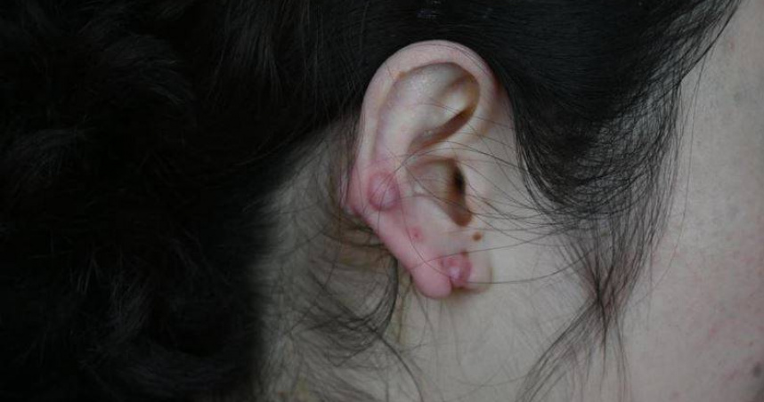 大陸湖北省武漢市一名陳姓女子長期佩戴耳環，平時幾乎不拿下來，導致耳垂長出「葡萄狀」疙瘩。（圖／翻攝自極目新聞）