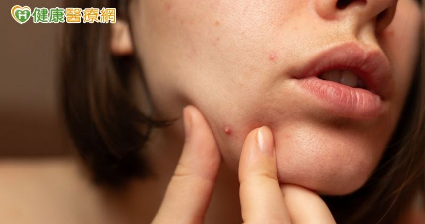 少女吃藥治痘痘  竟造成罕見「藥物性食道炎」！