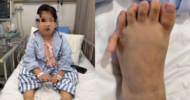 小蕓自幼發育明顯異常，身形與外觀長期停留在約6至7歲兒童階段，且雙足出現多指畸形。（圖／翻攝自揚子晚報）