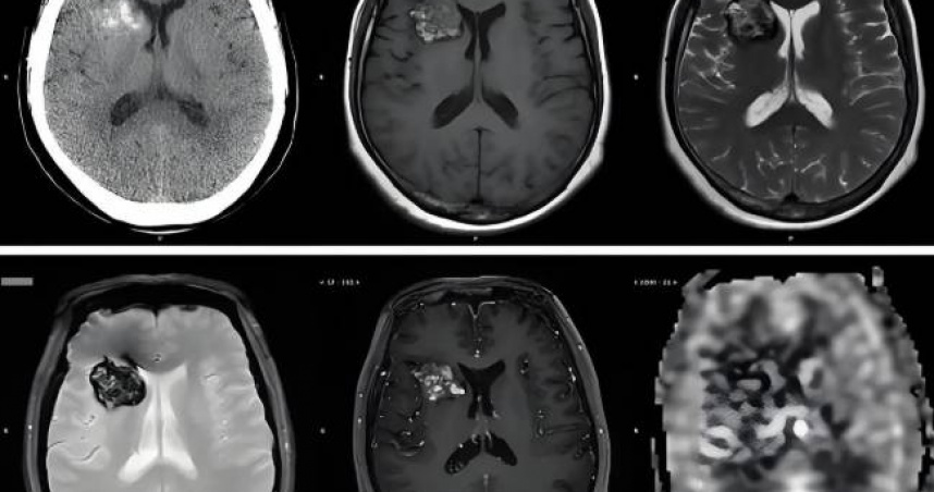 員工魏某經醫院診斷患有顱內血管瘤，醫囑明確要求避免熬夜。（圖／翻攝自MR亮哥說事）
