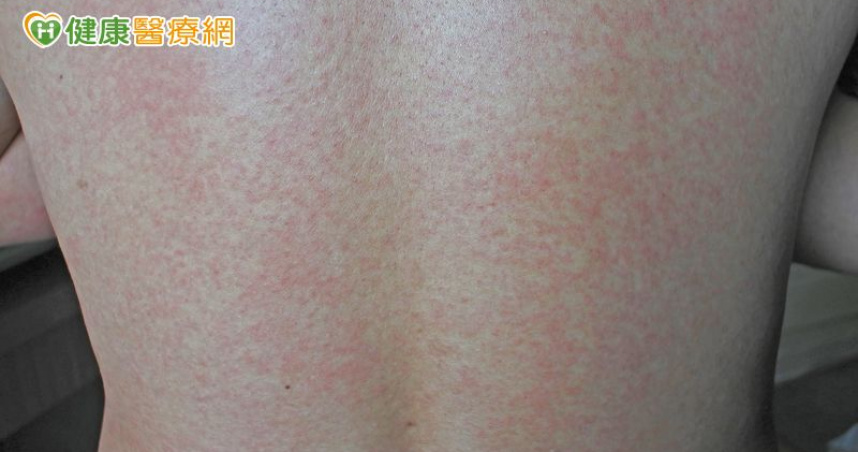 手腳冰冷不一定只是天氣冷　需留意自體免疫徵兆