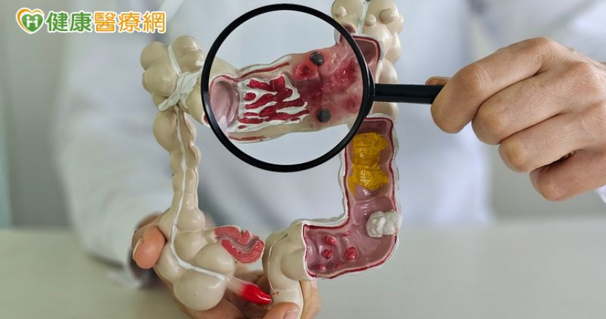 大腸癌年輕化！　台大研究證實：「提早10年篩檢」發生、死亡率雙雙下降