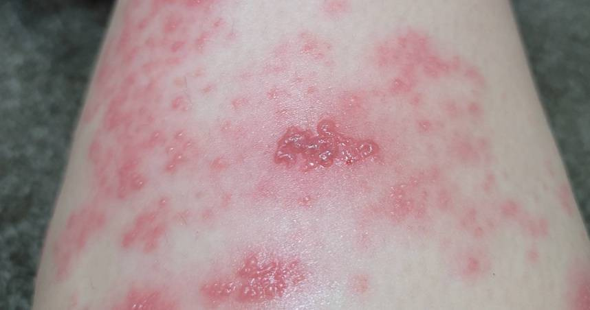 水痘為水痘帶狀疱疹病毒（varicella-zoster virus ）引起之高傳染性疾病。（示意圖／翻攝自photoAC）