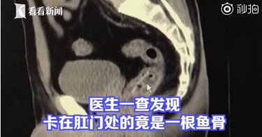 屁屁有異物頂住!男誤認痔瘡發作 醫檢查驚「3公分魚骨卡直腸」