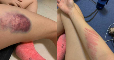 女大生意外墜樓!衝破雨遮「撞凹父愛車」 爸「第一反應」她躲起來痛哭