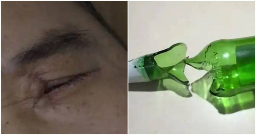 大陸一名男子被爆裂的啤酒瓶炸傷眼。（圖／翻攝小強熱線）