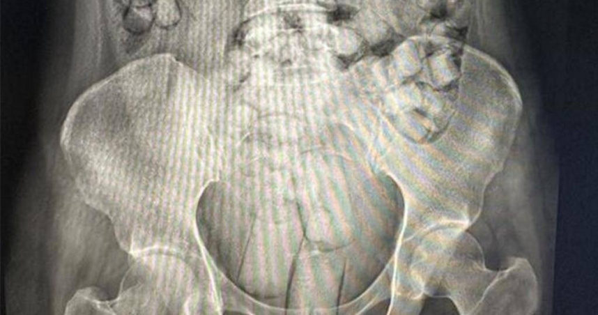 肛門塞毒、吞115顆海洛因球　兩泰女「人體運毒」闖小港機場遭重判