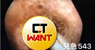 有片慎入!耳朵好癢拼命挖 醫生「完整取出」超大隻小強