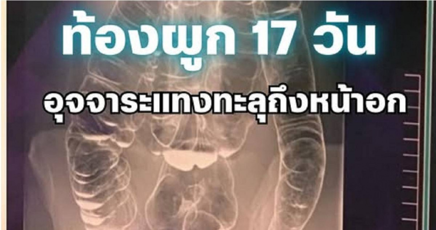 台灣一名女子因嚴重便秘，導致結腸被刺穿，病例在泰國引發重視。（圖／翻攝自臉書）