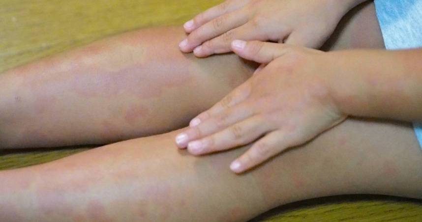 大陸7歲女童長紅疹，元凶是父親香港腳。圖僅示意，與本文無關。（示意圖／photoAC）