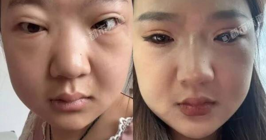 24歲女子暴肥29公斤，竟是確診尿毒症。（圖／翻攝中國報）