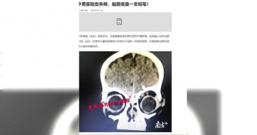 家長當心!一支鉛筆直刺眼眶5公分 1歲男童險失明