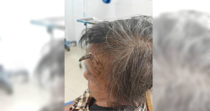 一名98歲的顧姓老婆婆額頭長出一枚形似「犄角」的贅生物。（圖／翻攝自環球網資訊）