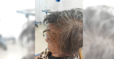 一名98歲的顧姓老婆婆額頭長出一枚形似「犄角」的贅生物。(圖/翻攝自環球網資訊)