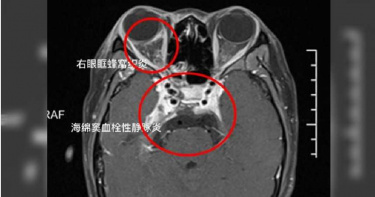 19歲女擠痘痘染腦膜炎 醫:再晚3天就沒命