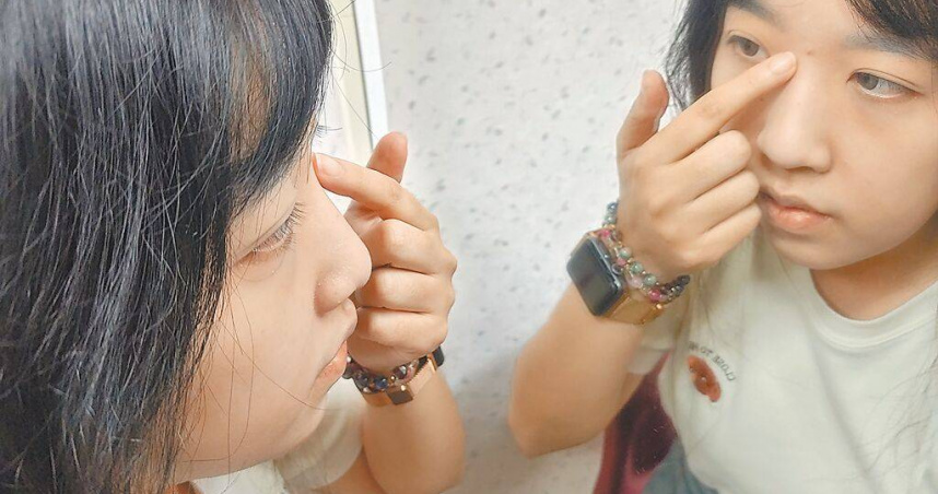 膚科醫師提醒，長痘痘千萬別亂擠，尤其臉上眉毛和鼻子之間的「三角區域」，細菌可能經由鼻竇跑到腦部，恐有生命危險。（圖／中國時報王家瑜攝）