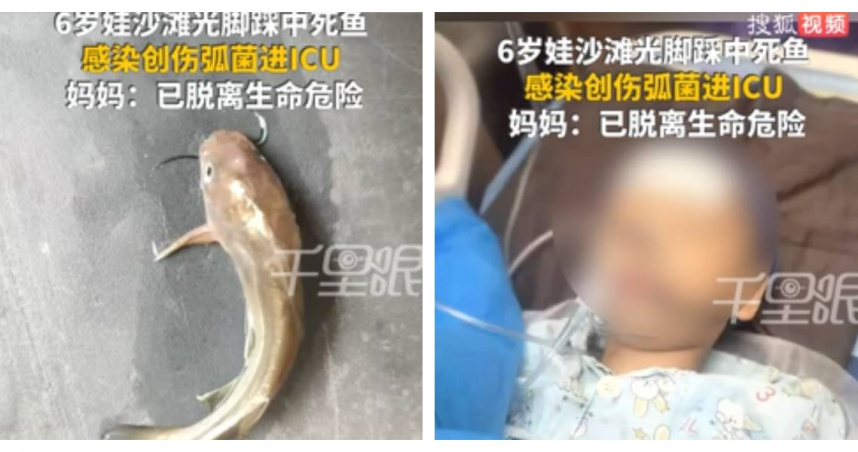 福建一名6歲男童赤腳在沙灘踩到死魚，不幸感染創傷弧菌。（圖／翻攝自微博， 搜狐千里眼 ）