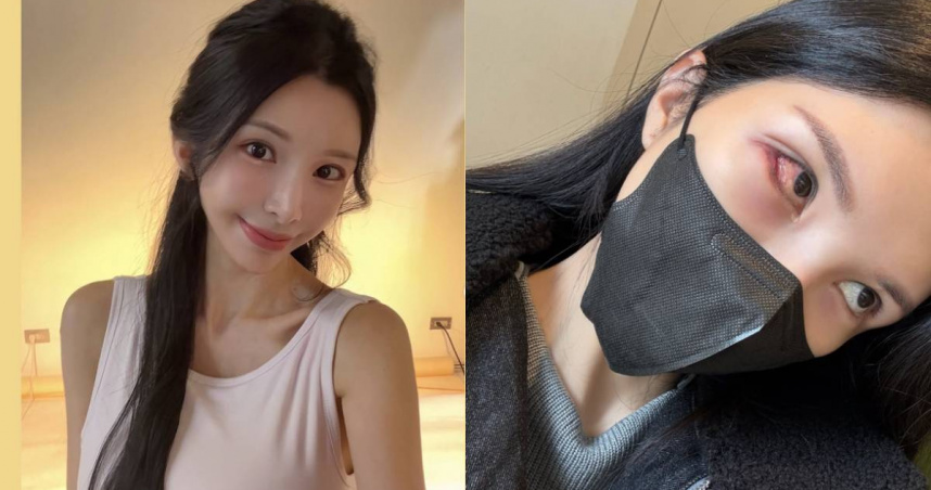 國光女神Lala「針眼惡化成蜂窩組織炎」　直呼好痛苦：不要輕忽