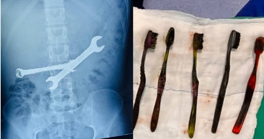 印度一名26歲男子腹痛就醫，經檢查發現他的胃裡有2把鐵扳手和7支牙刷，所幸在手術後已無生命危險。（圖／翻攝自X／ETV Bharat Rajasthan Team）