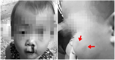 台東1歲女童疑被「打巴掌流血」關禁閉!哭到睡著 母痛訴公托虐童
