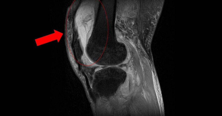 膝關節疼痛竟是結核菌引起。（圖／台中慈濟醫院提供）