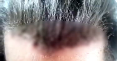 噁爆!男子髮間「上百隻頭蝨」爬竄 網崩潰喊:看了好想吐