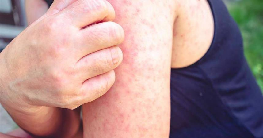 高雄市於1月17日出現首例麻疹境外移入確定病例。（示意圖／shutterstock）