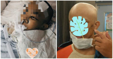 14歲少年「超罕見癌症」3度復發!半邊臉沒了:不想當怪人…付不起醫療費