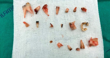 疏於照顧!4歲童20顆乳牙「蛀爛全拔光」只剩牙床